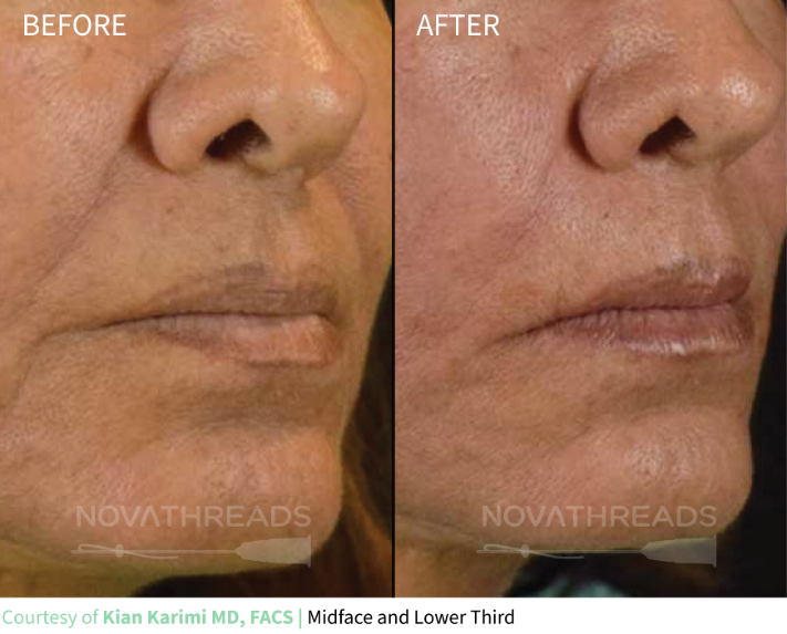 novathreads-kian-karimi-md-facs-midface-lower-third