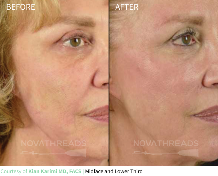 novathreads-kian-karimi-md-facs-midface-lower-third